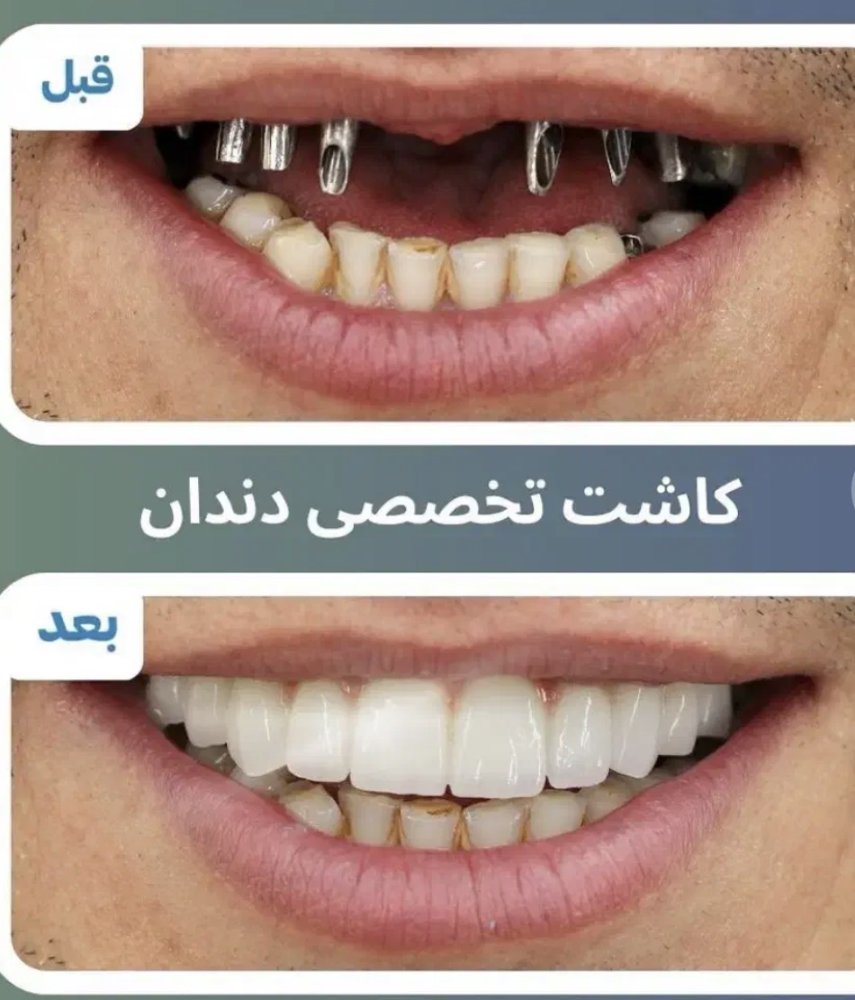 مرکزفوق تخصصی ایمپلنت دیجیتال/بدون درد/روکش فوری